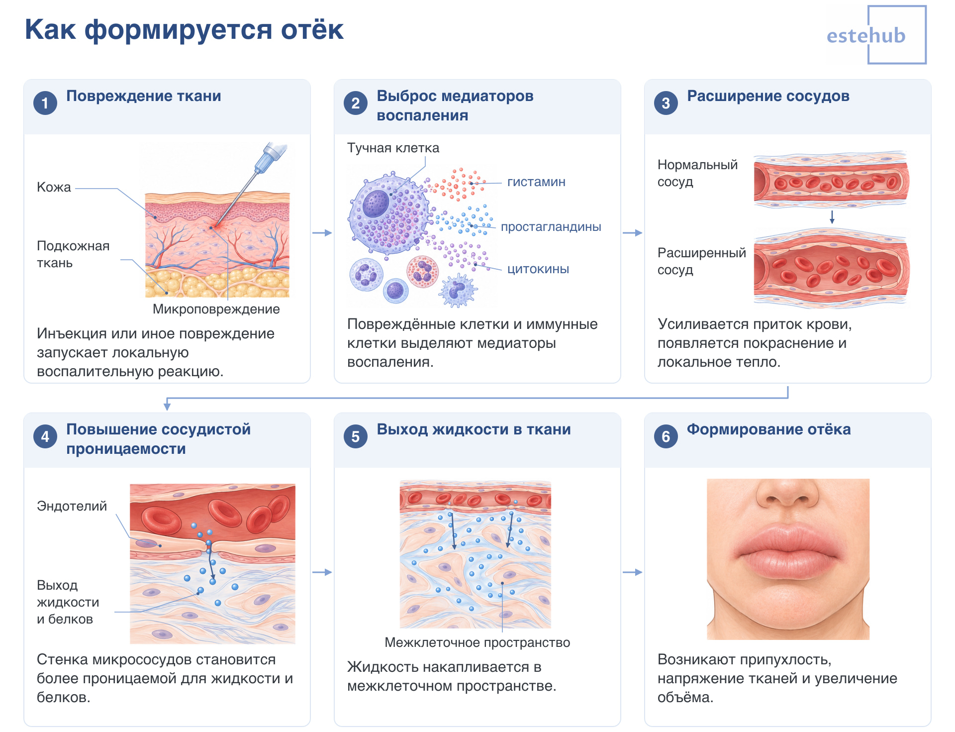 Как формируется отёк. Что такое отёк.